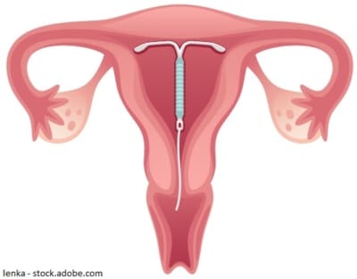 Sterilisationsalternative Hormonspirale